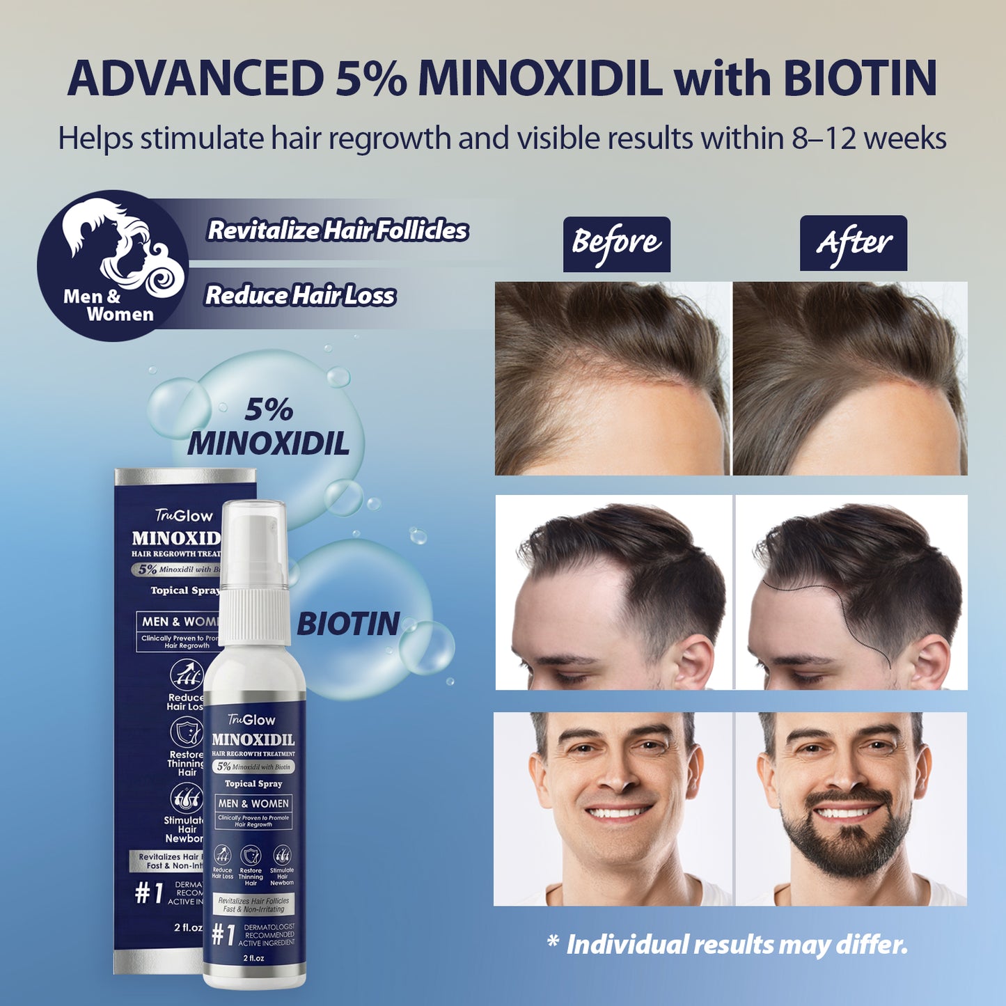 TruGlow 5% Minoxidil Hair Regrowth Treatment Spray for Men & Women
