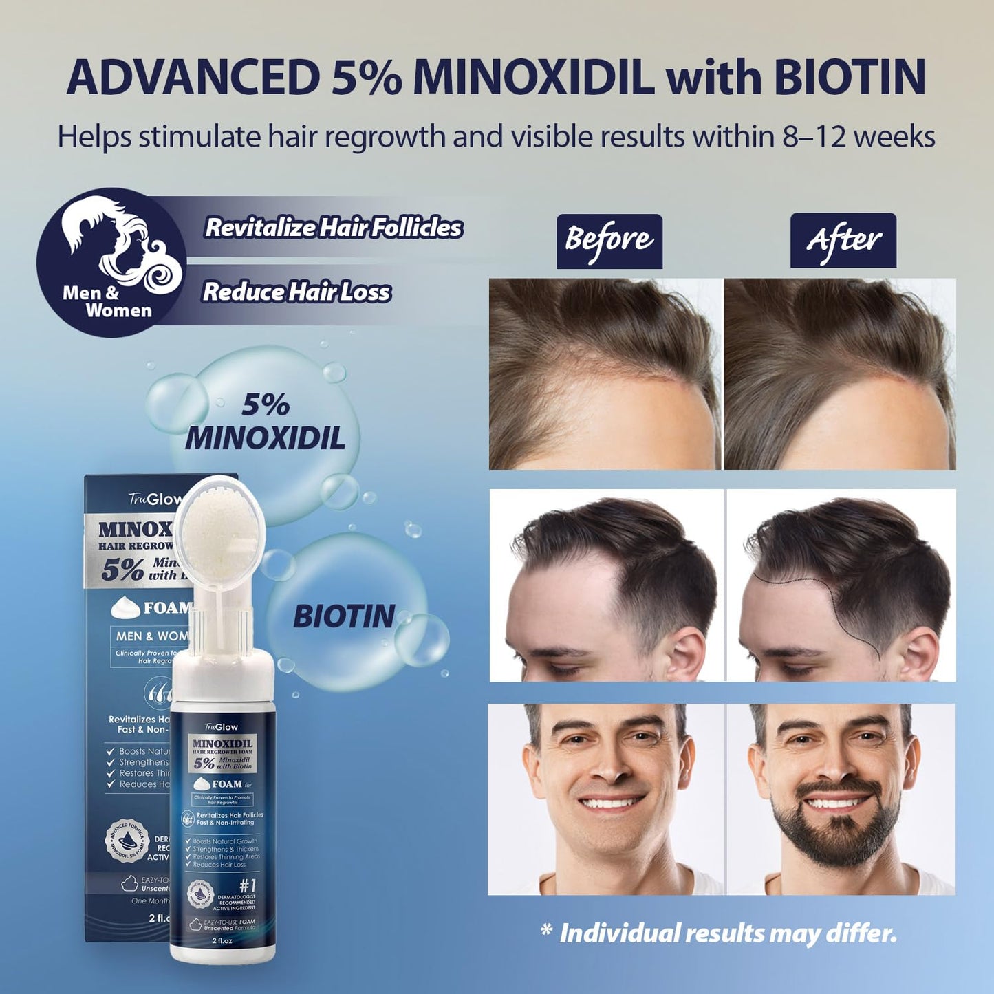 TruGlow 5% Minoxidil Hair Regrowth Treatment FOAM for Men & Women